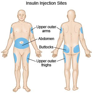 Printable Insulin Injection Site Chart