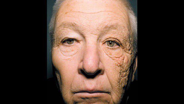 MomentumNut's tweet photo. Sun damage to window side of this trucker's face. Use sunscreen and exercise to increase skin health #SCANsymposium https://t.co/qOswSqYY1l