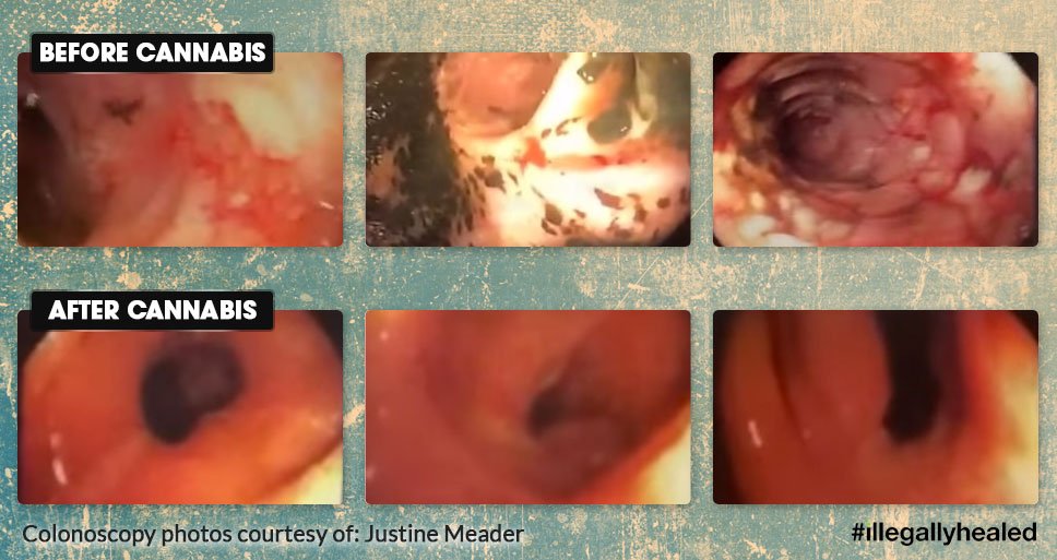 DustinDank_420's tweet photo. Juicing For My Crohn’s – The Justine Meader Story https://t.co/rGwa3WTiRD via @illegallyhealed https://t.co/4QtOZBvf6O