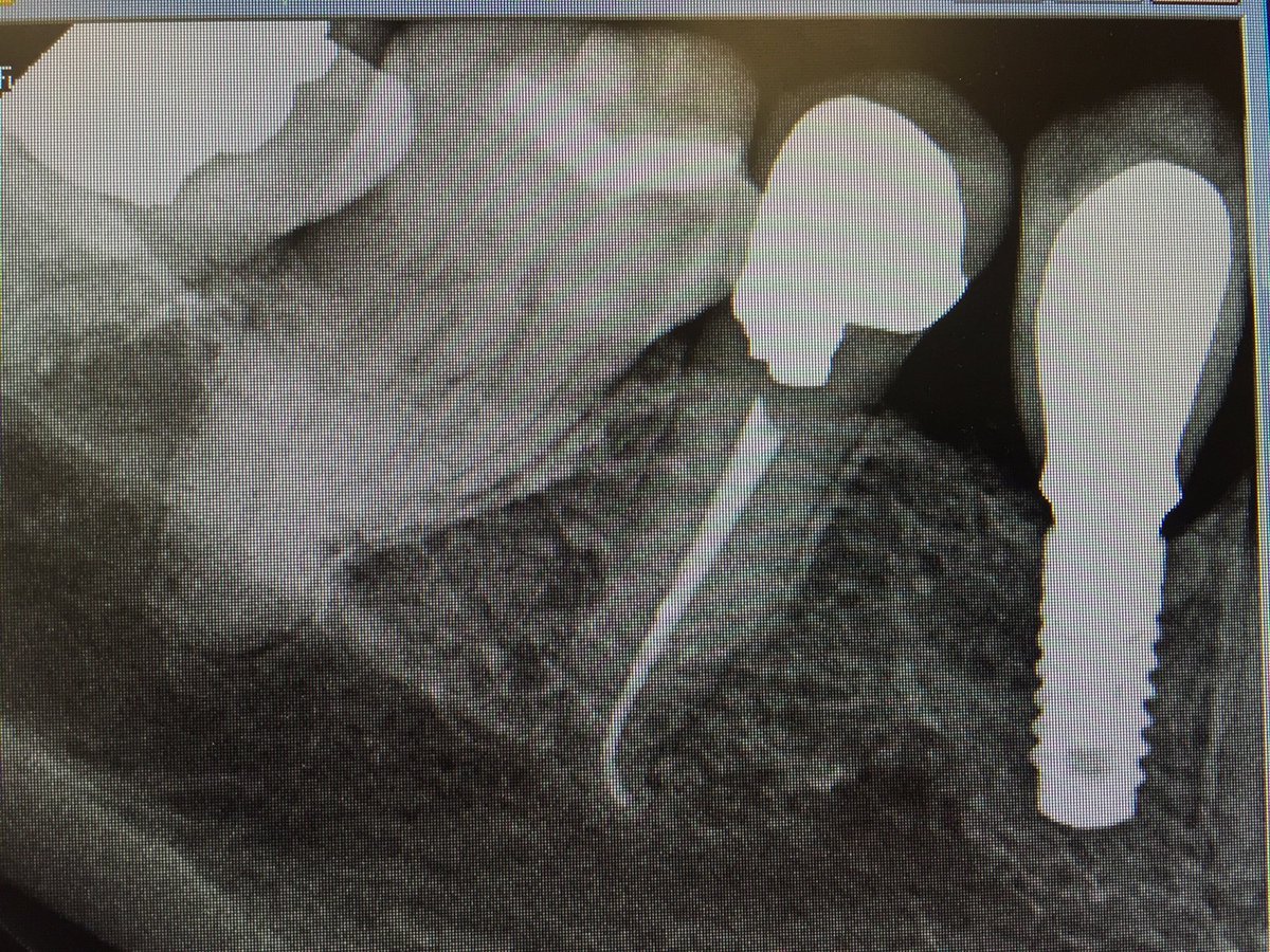 CryptoNagato_l's tweet photo. 6 year old narrow Roxolid implant in premolar. Part of NI study. #success. @DrRoxolid @StraumannUK @StraumannKeyAcc https://t.co/x768fKnVCn