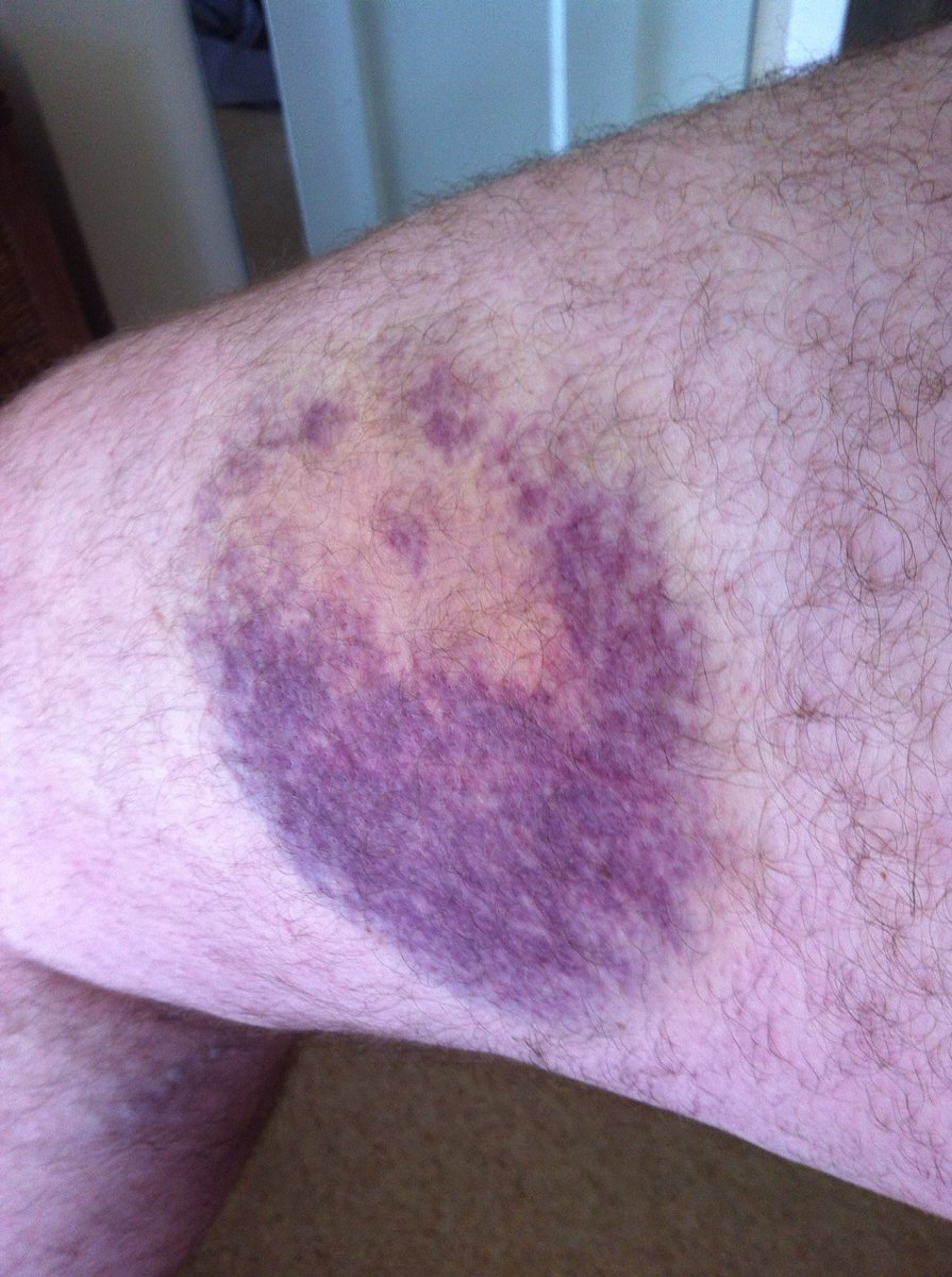 knowlesgtk's tweet photo. @LeighFrancis Rollerhockey hurts more. https://t.co/Z2BggkiMu4
