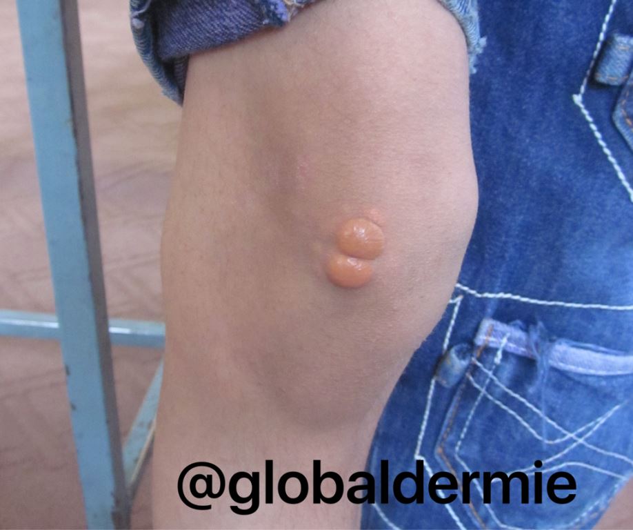 globaldermie's tweet photo. 10yo Afghanistan w/ #xanthomas knees & elbows Chol541 LDL467 familial #hypercholesterolemia #dermatology #globalderm https://t.co/ICDxSt8APa