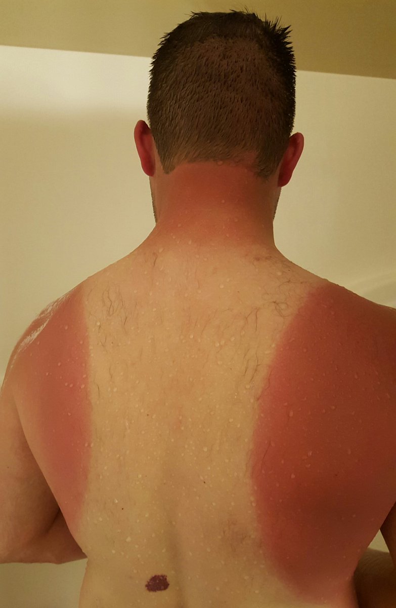 Madd_dog2020's tweet photo. Reason number 639593728495 why you don't wear a cutoff while doing yard work https://t.co/k2TIrNAx5O