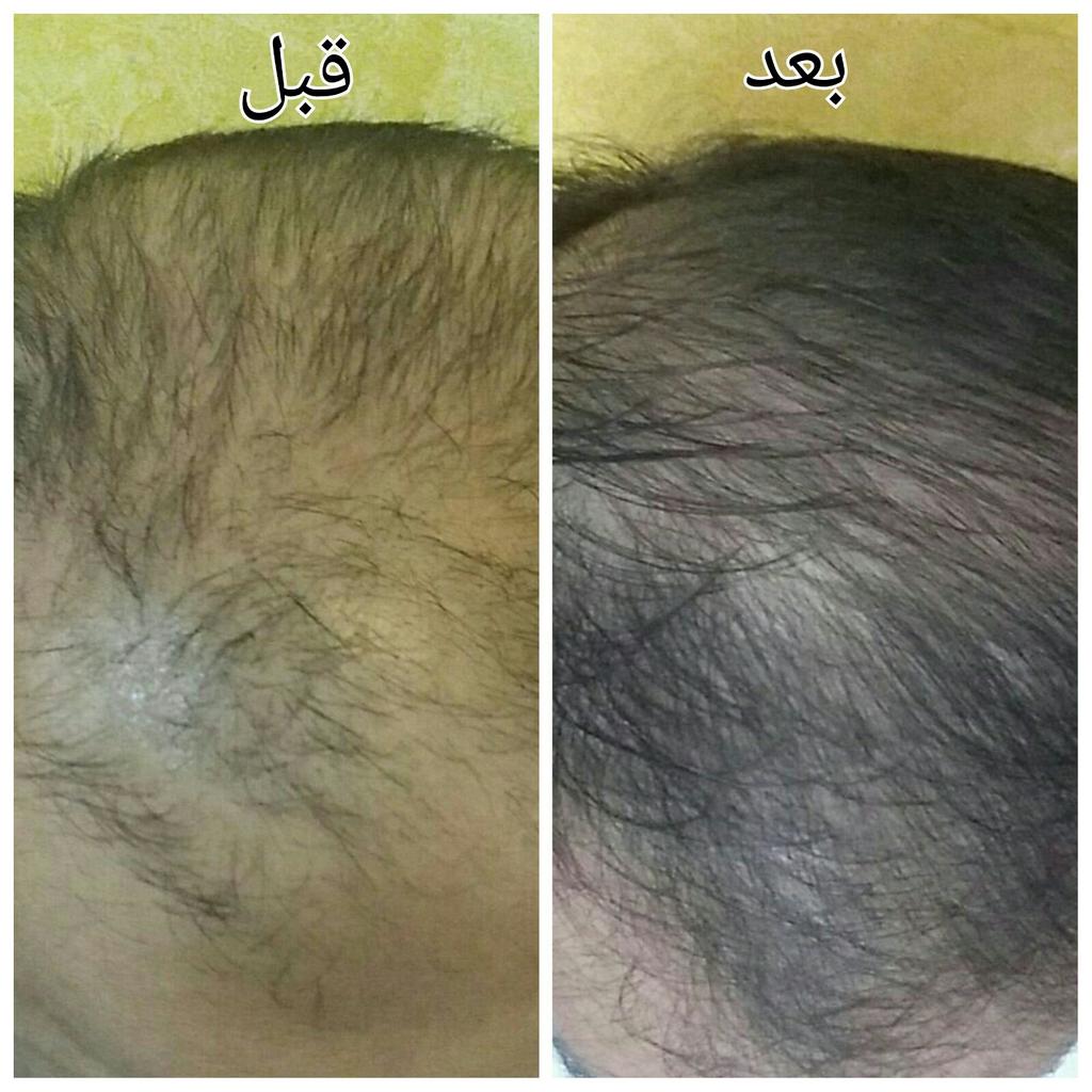 al_zait's tweet photo. زيت الحشيش الافغا
الحل الامثل لمشاكل الشعر والدقن
يمنع التساقط
ينعم
يكثف
يطول
للتواصل 0557931881👌
مجرب ومضمون https://t.co/H2HYqusCdg
