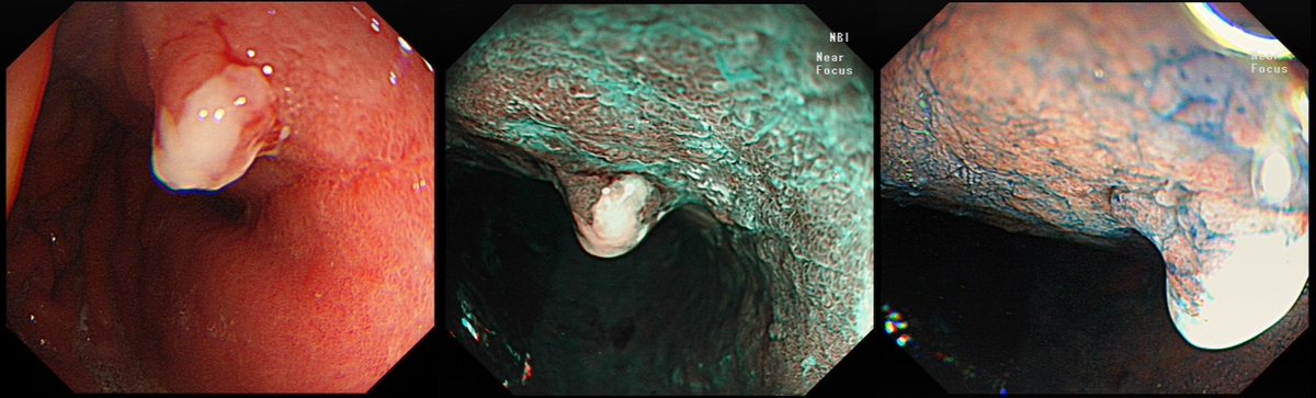 Bjorn_Rembacken's tweet photo. Small incidental nodule at gastric fundus
a) hyperplastic
b) carcinoid
c) adenoma
d) IMca
e) invasive cancer https://t.co/fAuwLSMqwk
