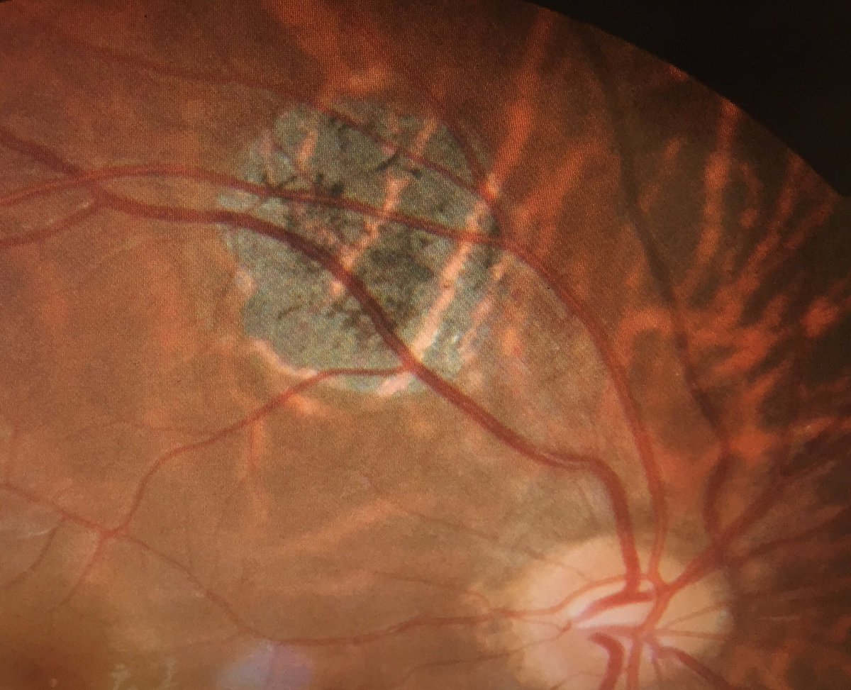 BHEyeGuy's tweet image. Young patient in his 20s with a Chorioretinal Scar second to eye trauma #retina #eyestuff #imaging #bheyeguy
