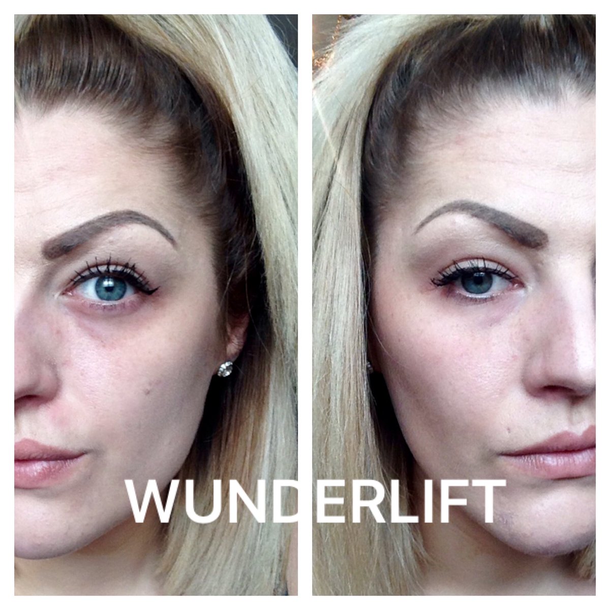 wunderlift eye
