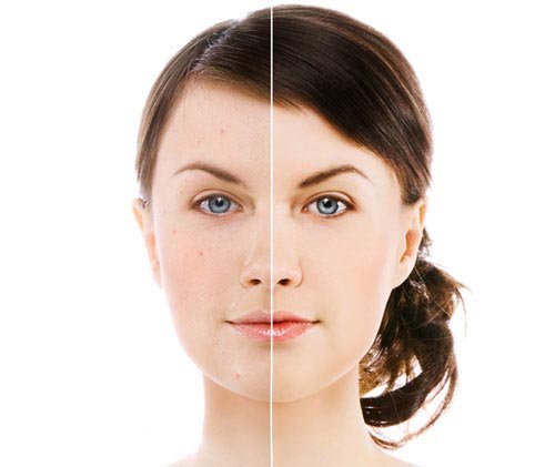 Sivilce_Kremi's tweet image. #ACNEMAX İLE #SİVİLCELER BİTİYOR!
aknetedavisi1.wordpress.com