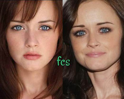 fcsurgery's tweet photo. https://t.co/JfEQZqyo97
#plasticsurgery #alexisbledel  @2PlasticSurgeon  #MovieAwards https://t.co/G0qwcC9YOz