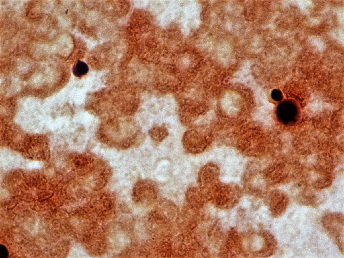 LSUHSCID's tweet photo. Picture quiz1: AIDS pt BCx w/budding yeast. Serum Crypto Ag negative.  Chromagar is mauve. What is this? https://t.co/Rl0CmmaXFw