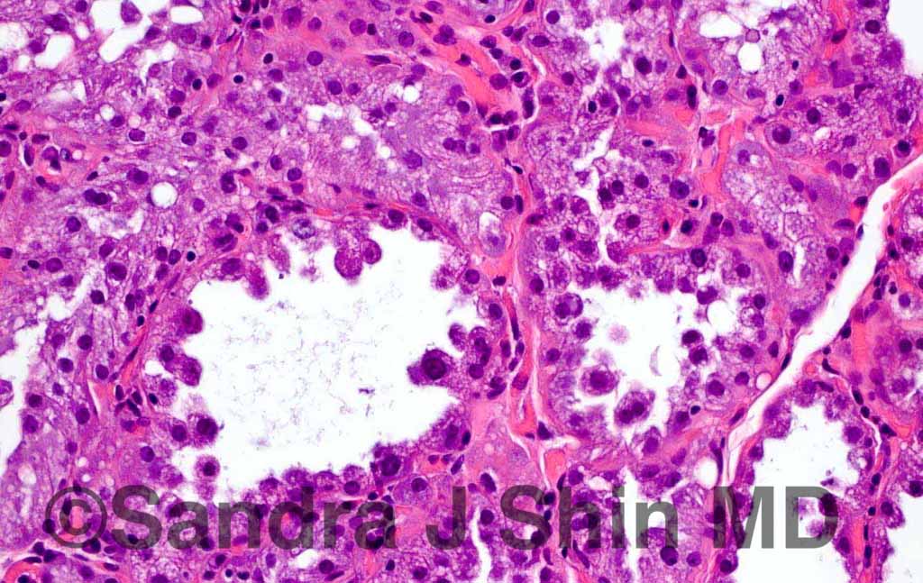 brstpathology's tweet photo. #brstpath Pregnancy-like (pseudolactational) hyperplasia with calcs can be mistaken for ADH in the core bx setting https://t.co/ODzfUZFg5I