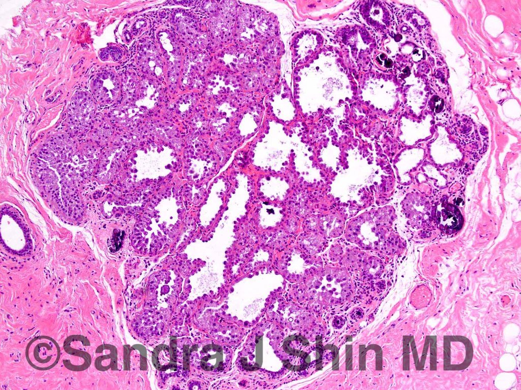 brstpathology's tweet photo. #brstpath Pregnancy-like (pseudolactational) hyperplasia with calcs can be mistaken for ADH in the core bx setting https://t.co/ODzfUZFg5I
