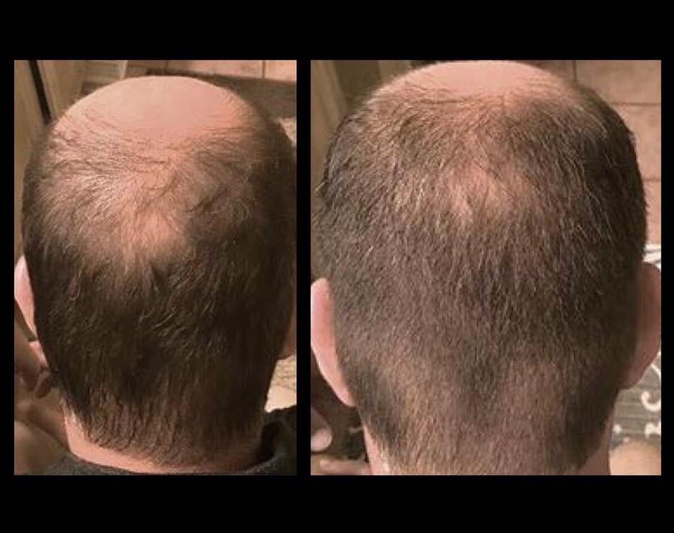 Nofap hair growth