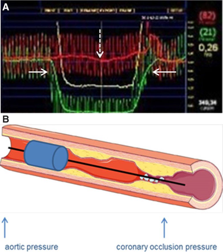RevEspCardiol's tweet image. Coronary collateral growth induced by physical exercise #FreeScience via @CircAHA ow.ly/4mPnvA