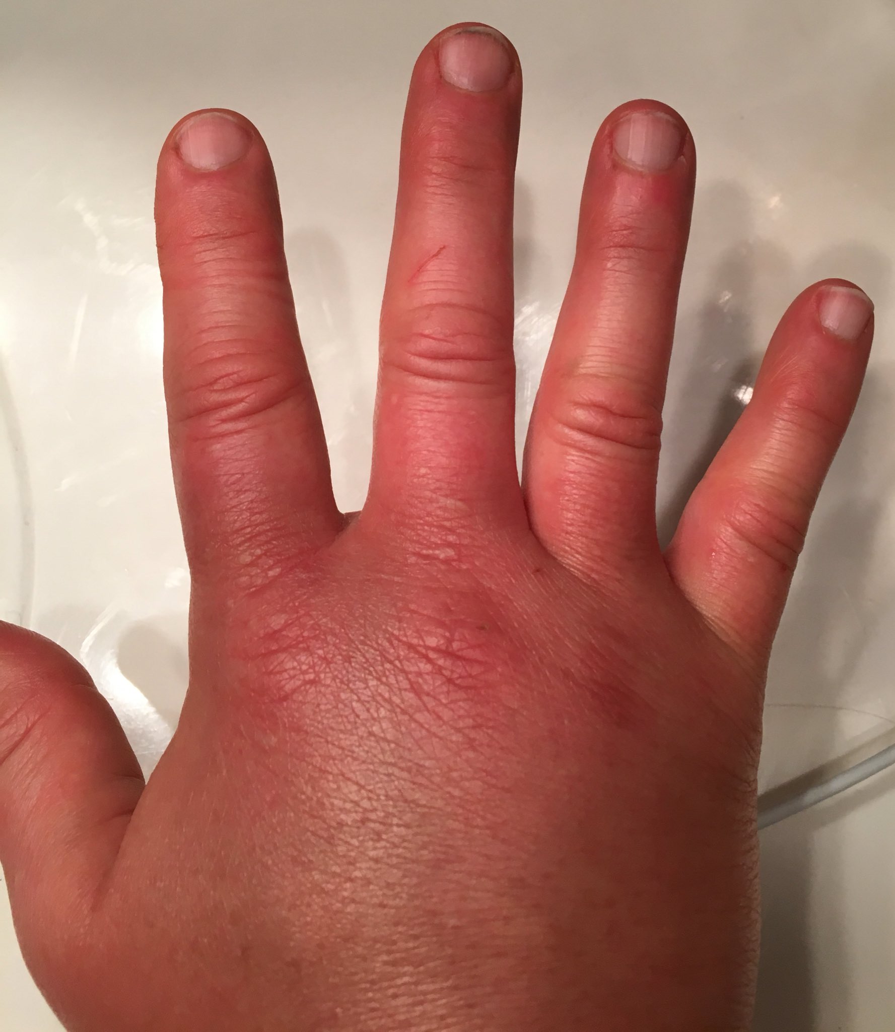 Peggy on Twitter: "Severe allergic reaction. Weird that red swelling stop at 1st joint. Is that lymphatics end? @annesperling1 https://t.co/FAuldAkEIh" / Twitter