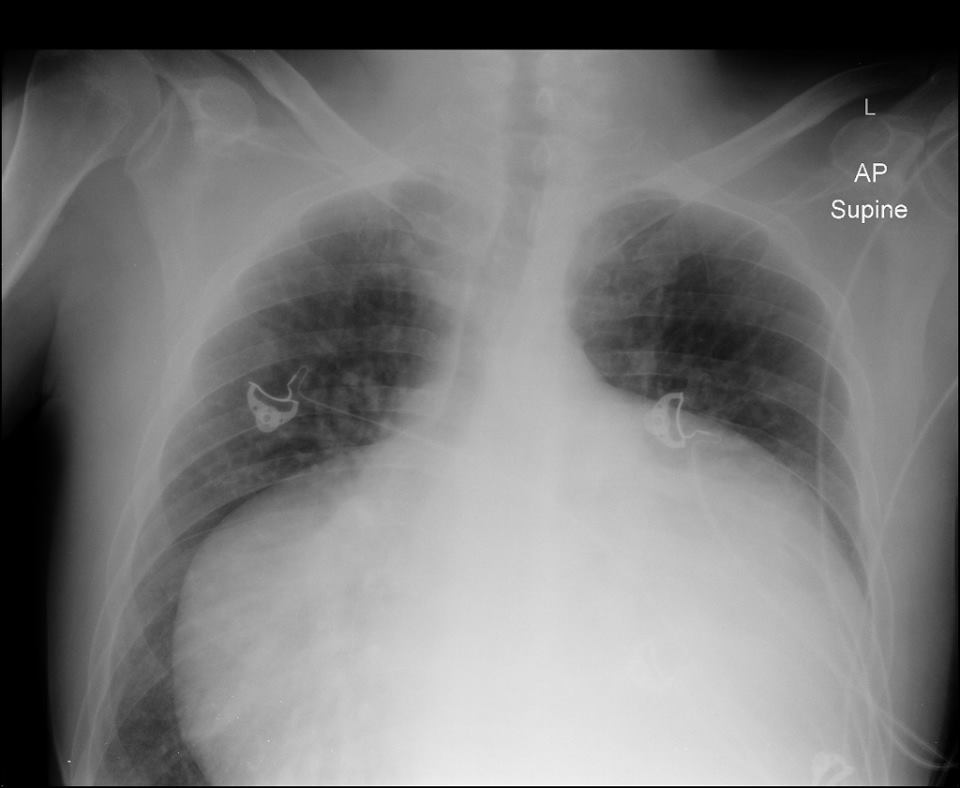 RadiologySigns's tweet photo. Q: Do you know the name for this distinct form of cardiomegaly? ANSWER: https://t.co/VmtROncSux #FOAMrad #FOAMed https://t.co/Z87IKlXW4h