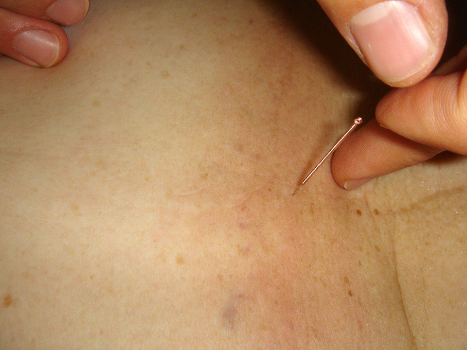 suefalsone's tweet photo. Why #dryneedling is the perfect relief for this woman's #musclesspasms. https://t.co/2LrhH5dFSH https://t.co/Grnrdahiqy