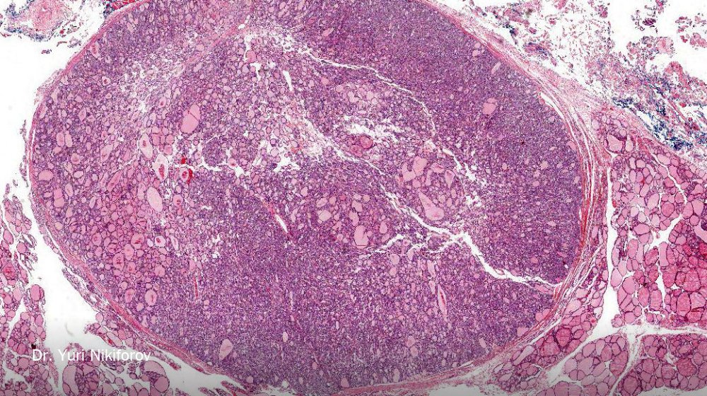 NYTHealth's tweet photo. Turns out thousands of thyroid cancer patients didn't actually have cancer https://t.co/4It1OvnRdI https://t.co/64dkOLPCbA