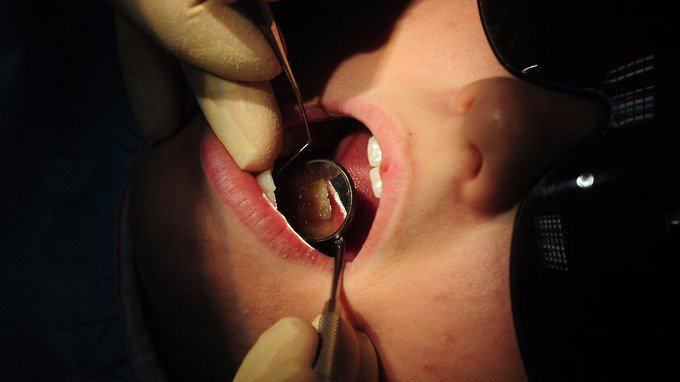 itvnews's tweet image. Children's rotting teeth costs hospitals £35 million a year, councils warn itv.com/news/2016-04-1…