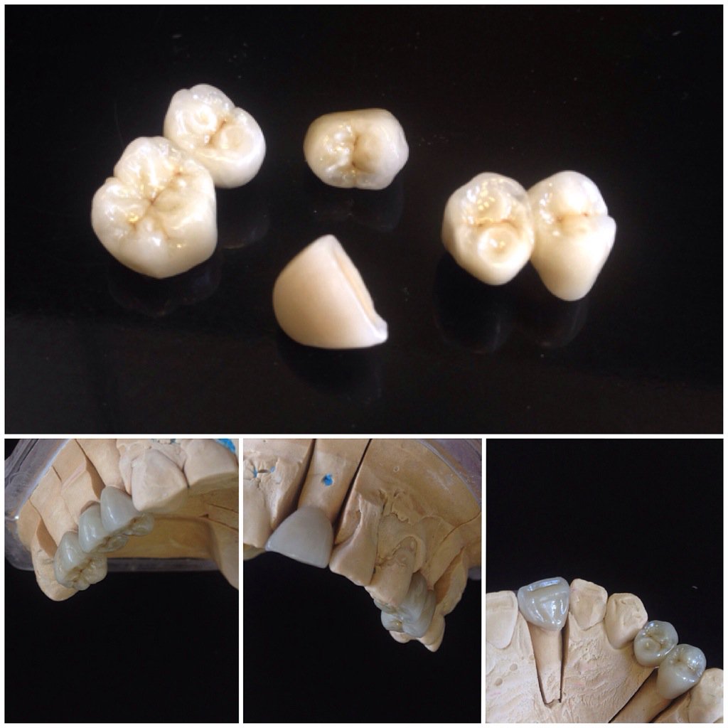 DSDdentallab's tweet photo. Layered Zirconia Crowns &amp; Bridges! #zirconia #crowns #bridge #teeth #dental #dentistry #dsddental https://t.co/IwCdNYjbXS