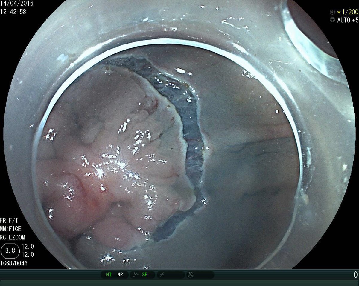 ESD for cecal lesions with morphology and pattern predicting advanced histology