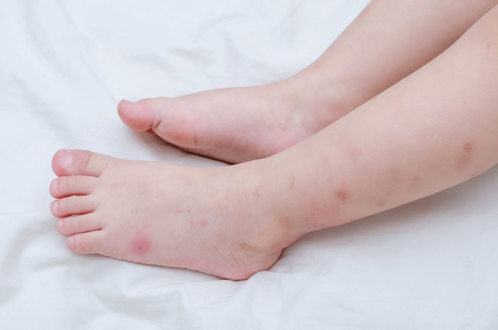 HdKnowledge's tweet image. How long do bed bug bites last ? - lifegot.com/how-long-do-be…