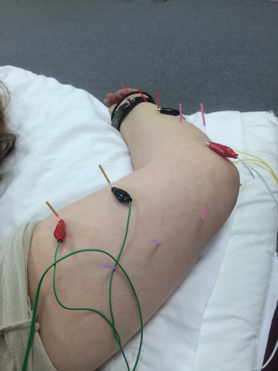 jwilkinsonDPT's tweet photo. Ending the day tracking down some nerves!! #lovept https://t.co/EyoaXu5JV6