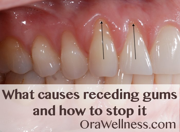 What Causes Receding Gums and How to Stop it - dld.bz/ezVDV