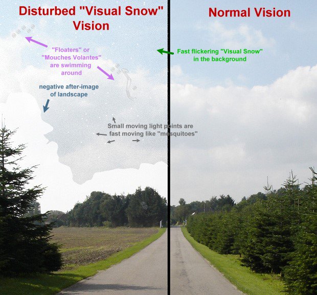 causes entoptic phenomena causes entoptic phenomena