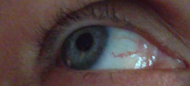 UberFacts's tweet photo. This woman has a blood vessel in her eye that seems to spell the word "love." https://t.co/cHpqWNn7CQ