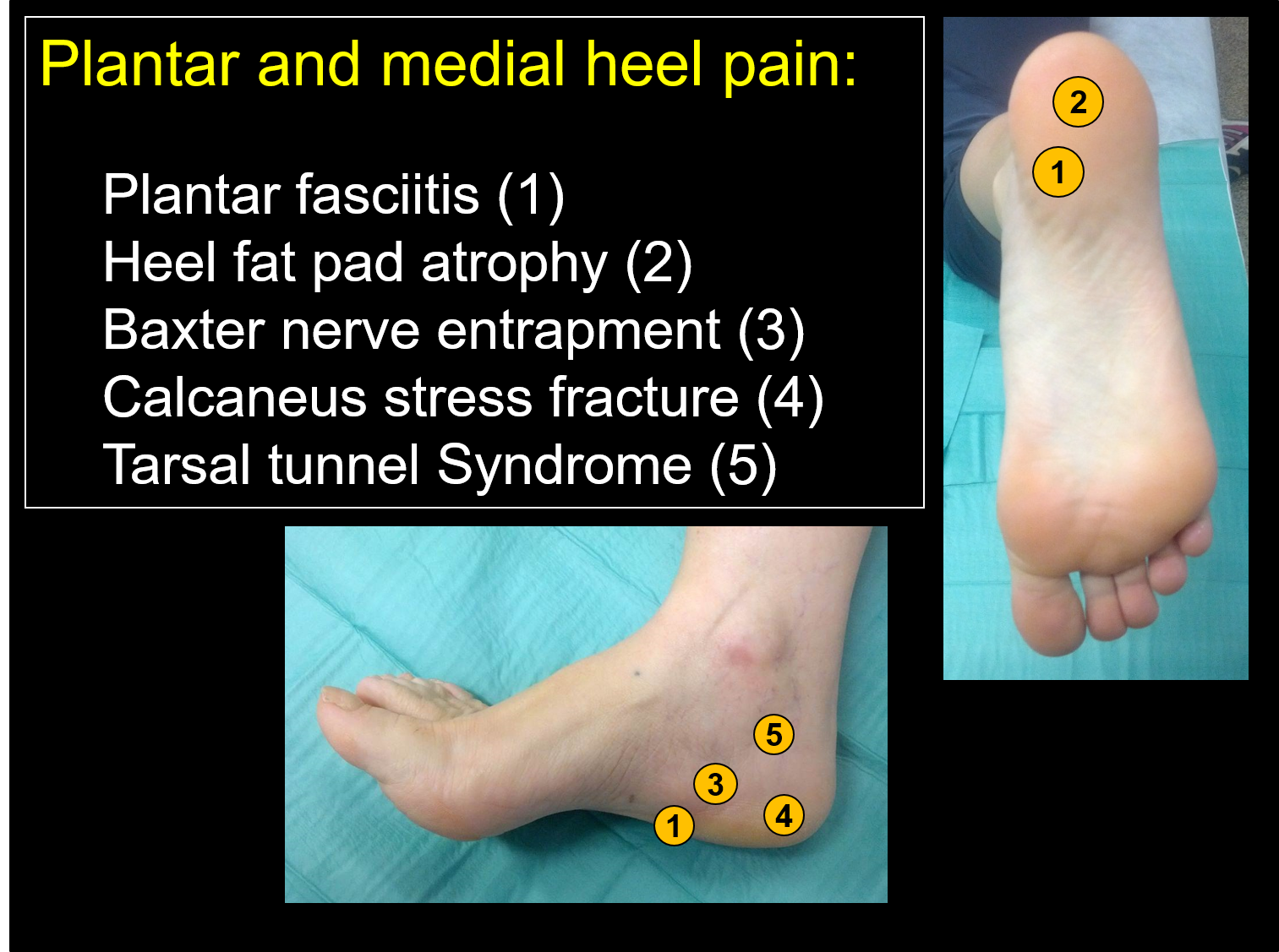 Heel Pain, Heel Spur Treatment & Plantar Fasciitis | Wairarapa | Masterton