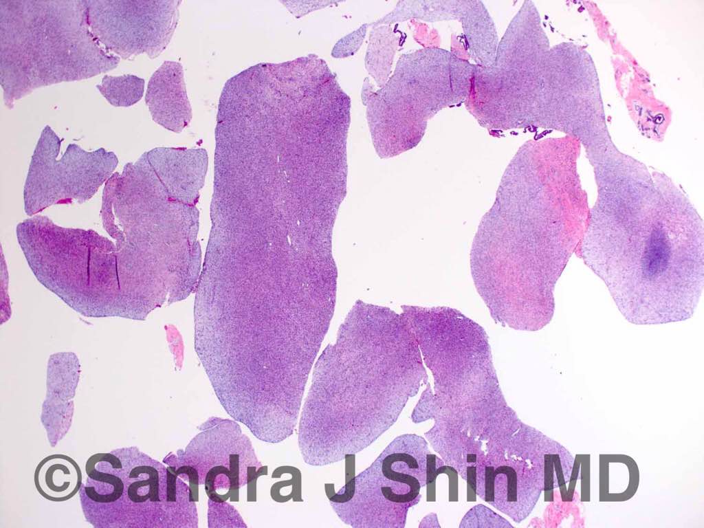 brstpathology's tweet photo. #brstpath A spindle cell tumor in core bx (L) can be a phyllodes tumor where the epithelial component goes unsampled https://t.co/qI0saVv4eL