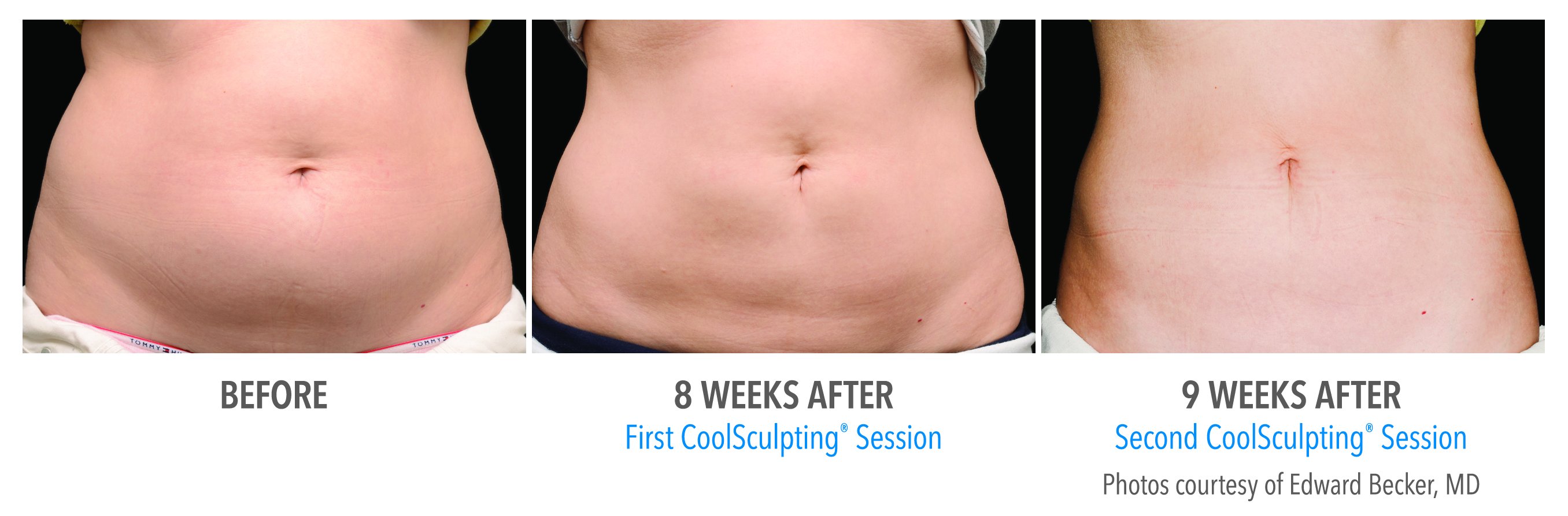 Freeze away stubborn fat without surgery! #coolsculpting. 