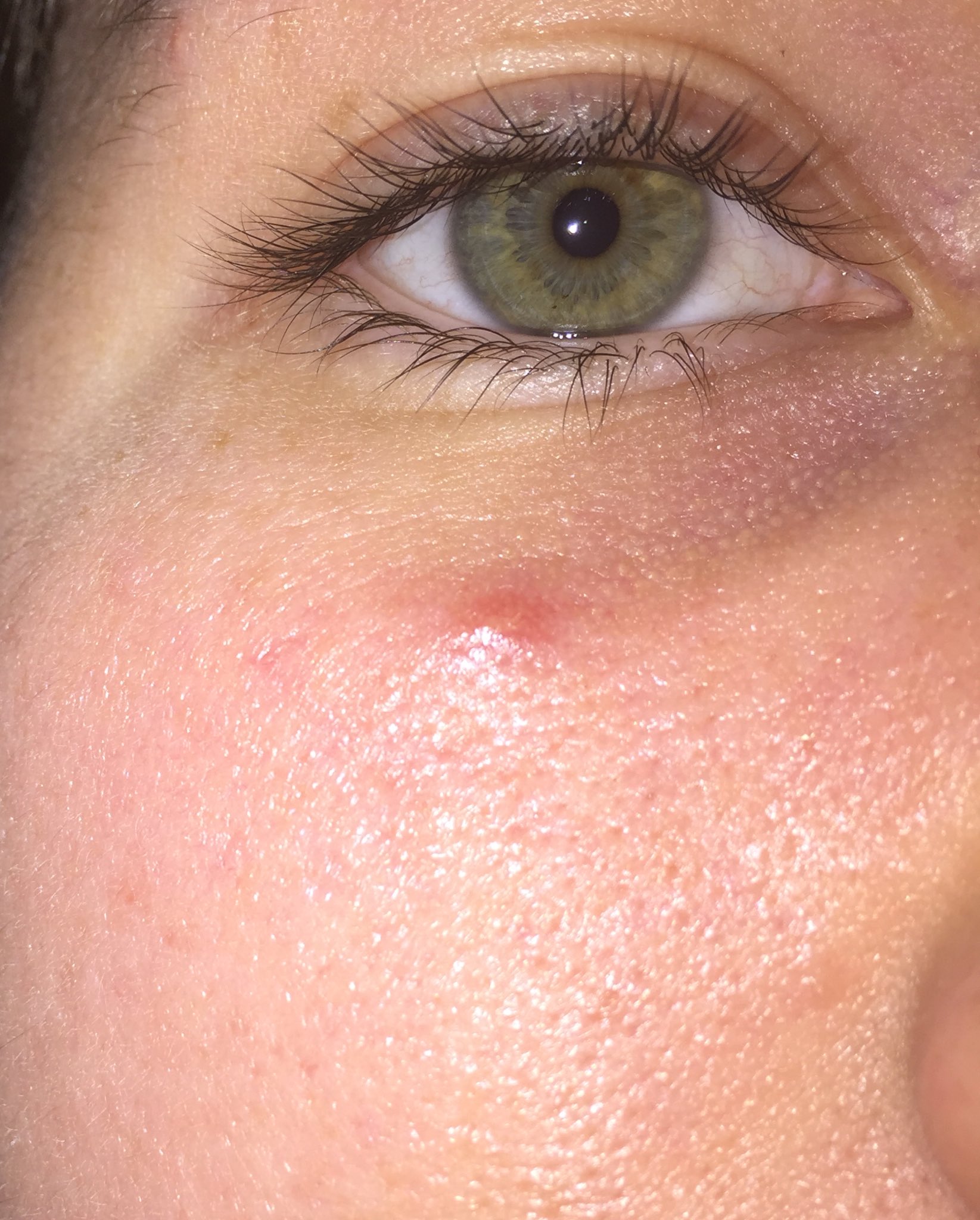 Skin concerns Need help with this huge red pimple thats causing my under eye to swell Has anyone experienced something similar Routine in the  comments  rSkincareAddiction