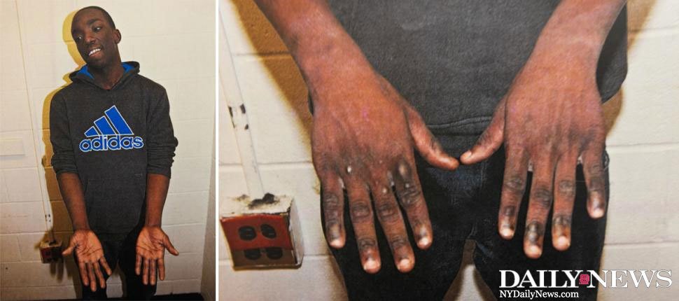 NYDNLocal's tweet photo. Burned and bruised hands of accused teen pyromaniac could be key clue in killer fire case https://t.co/sUYPcMUelm https://t.co/tbid5Jgwmd