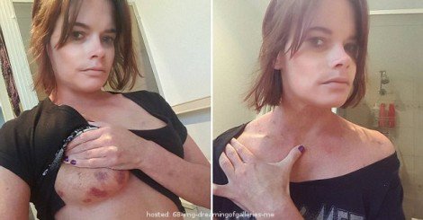 Woman Raped By Her Online Date Shares Her Injuries 
 bit.ly/1XVdwkP