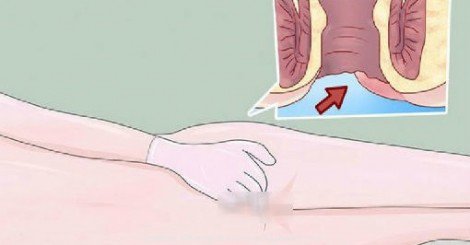 Early-Warning Signs Of Anal-Cancer Everyone Is TOO Embarrassed To Talk About
 bit.ly/1XVdFog