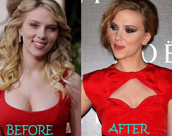 Scarlett Johansson Breast Reduction Before & After See Full Story at he...
