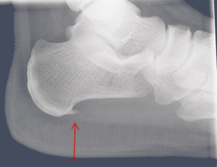 Que es el Espolon Calcaneo y Como Eliminarlo atletismoarjona.com/mis_propios_ar…