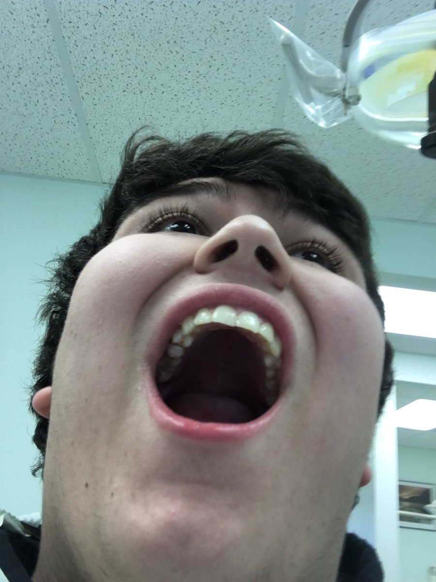 So i got a bridge drilled through my terth bc of cavities and i got pics boi fucking metal