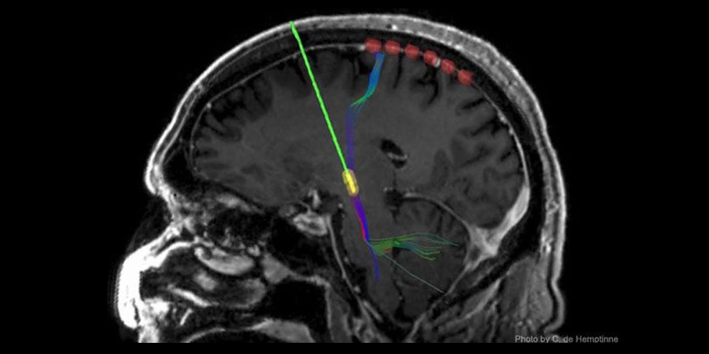 UCSFHospitals's tweet photo. Deep-brain stimulation can rapidly improve #Parkinsons disease. Here's how: https://t.co/j1tN38Twf9 #UCSFNeuro https://t.co/yPhZyqvExc