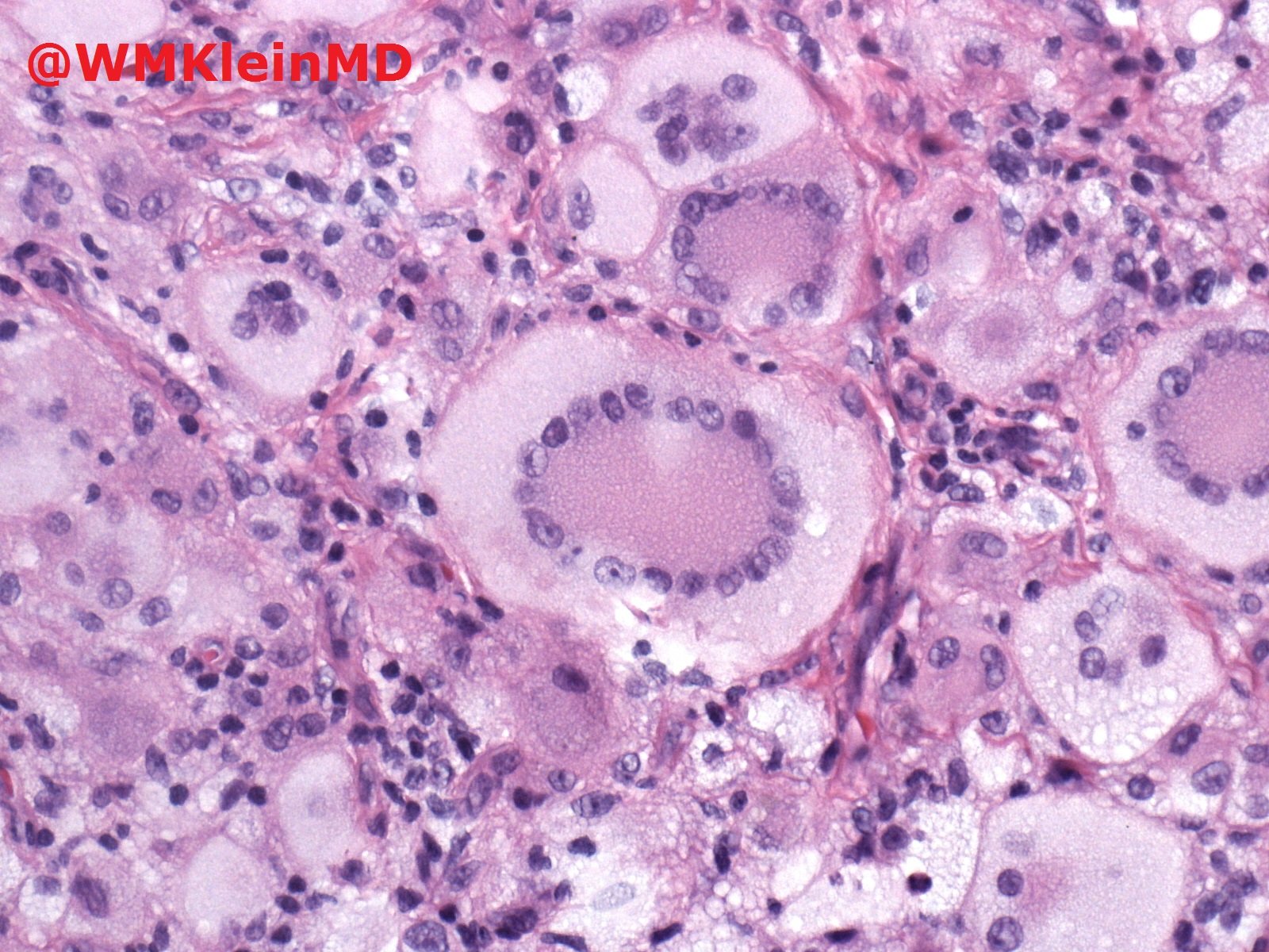 Walter Klein MD on Twitter: "Beautiful example of #xanthogranuloma with