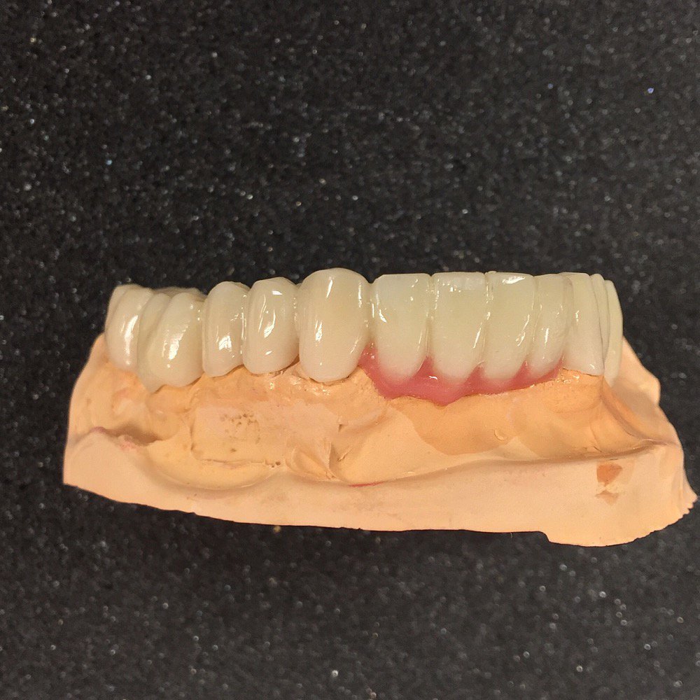 PoseyDentalLab's tweet photo. Milled long-term #provisional. #poseydentallab#dental#dentistry #provisional#dentallab#dentaltech #cosmeticdentistry https://t.co/1PXPYWFNHe