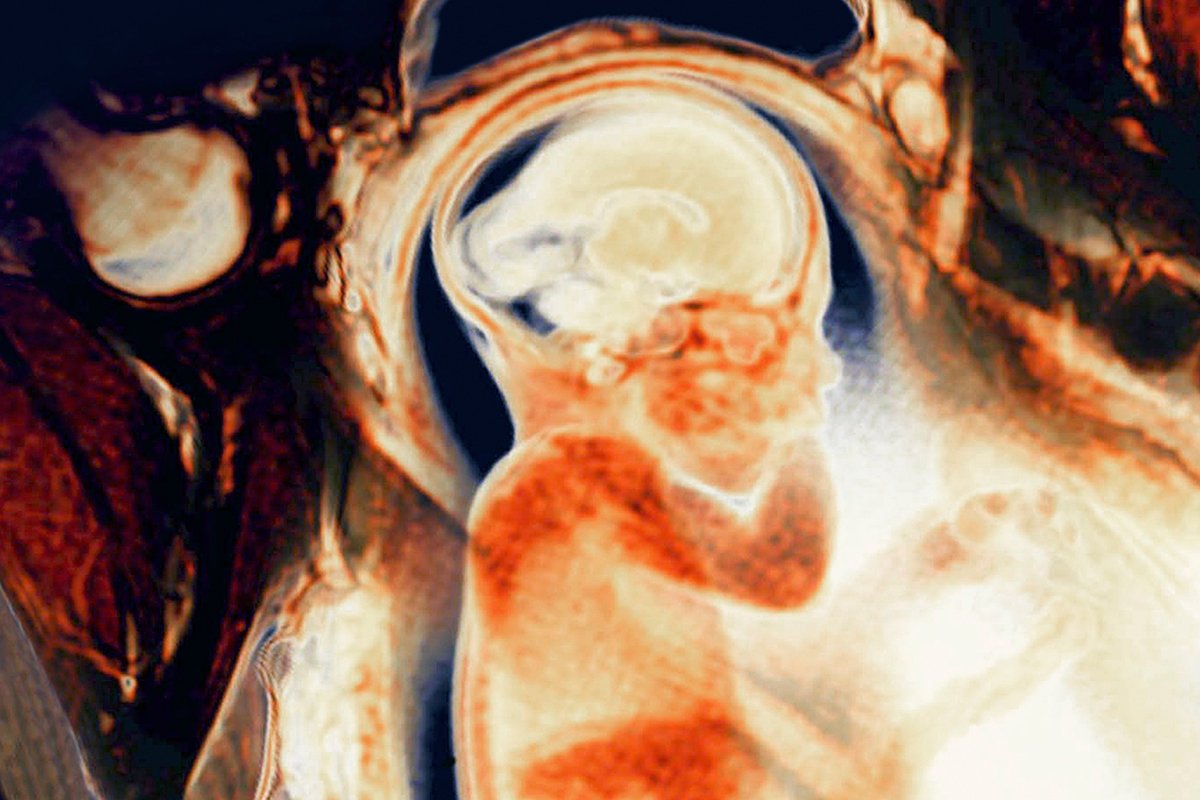 newscientist's tweet photo. The foundations of schizophrenia may be laid down in the womb https://t.co/qDjdLiNnXz https://t.co/YDnujUgoXg