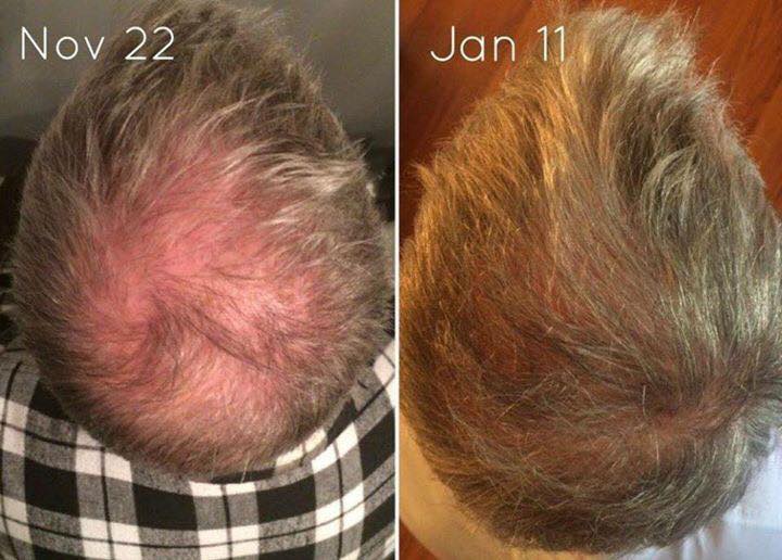 MONAT4yourHair's tweet photo. For MEN also...This man was balding for 5 yrs &amp; after 3mo on MONAT he started seeing results. #balding #nochemicals https://t.co/6wBOLA5bSE