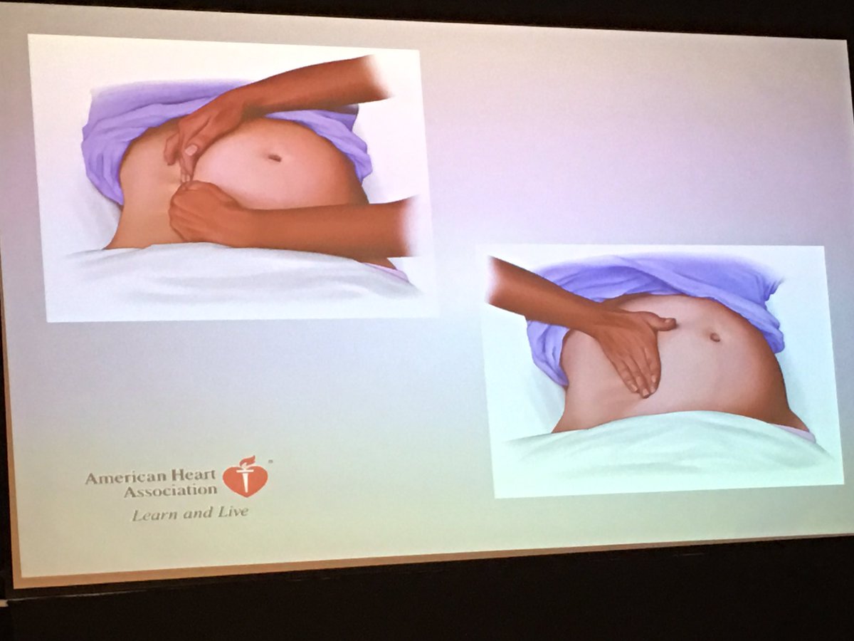 jamesbolton2222's tweet image. #ALSinstructor better than wedges and pillows or knees for preventing ACC