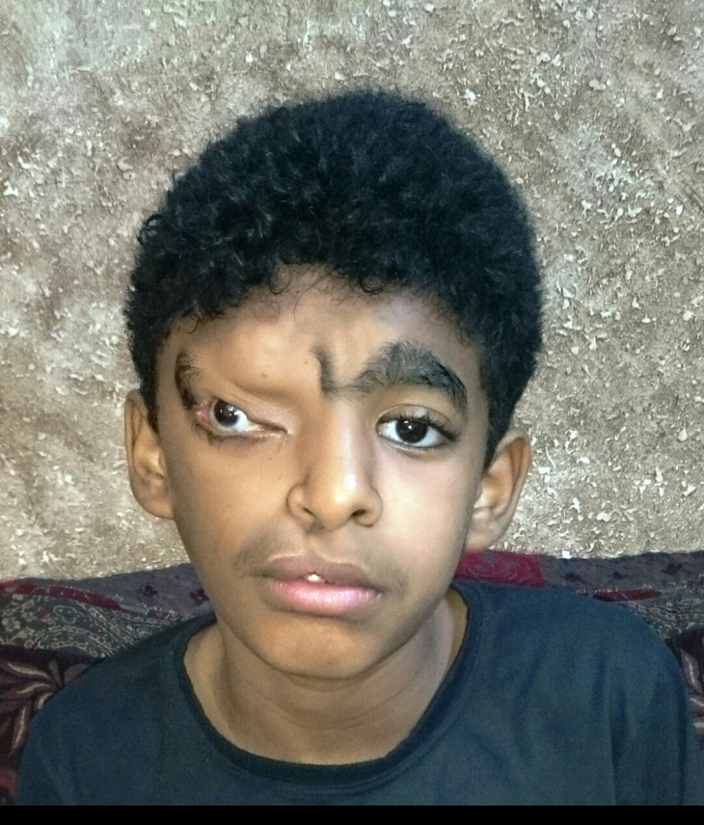 <a href="/fayez_malki/">فايز المالكي</a> يمني عمره 13 عاما يعاني من ورم فوق العين اليسرى يحتاج الي عملية جراحية