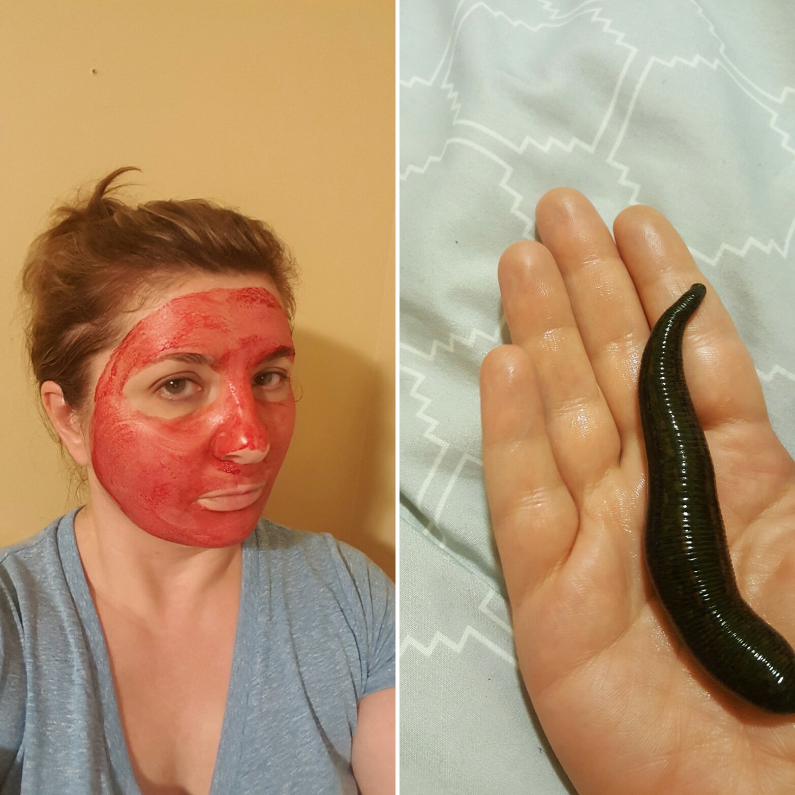 Leech Therapy on Twitter: "ancient blood facial 2 keep wrinkles away.Your  own bld squeezed from guts of leech after leech therapy. 200 enzymes!  https://t.co/3OVm75JJ7t" / Twitter