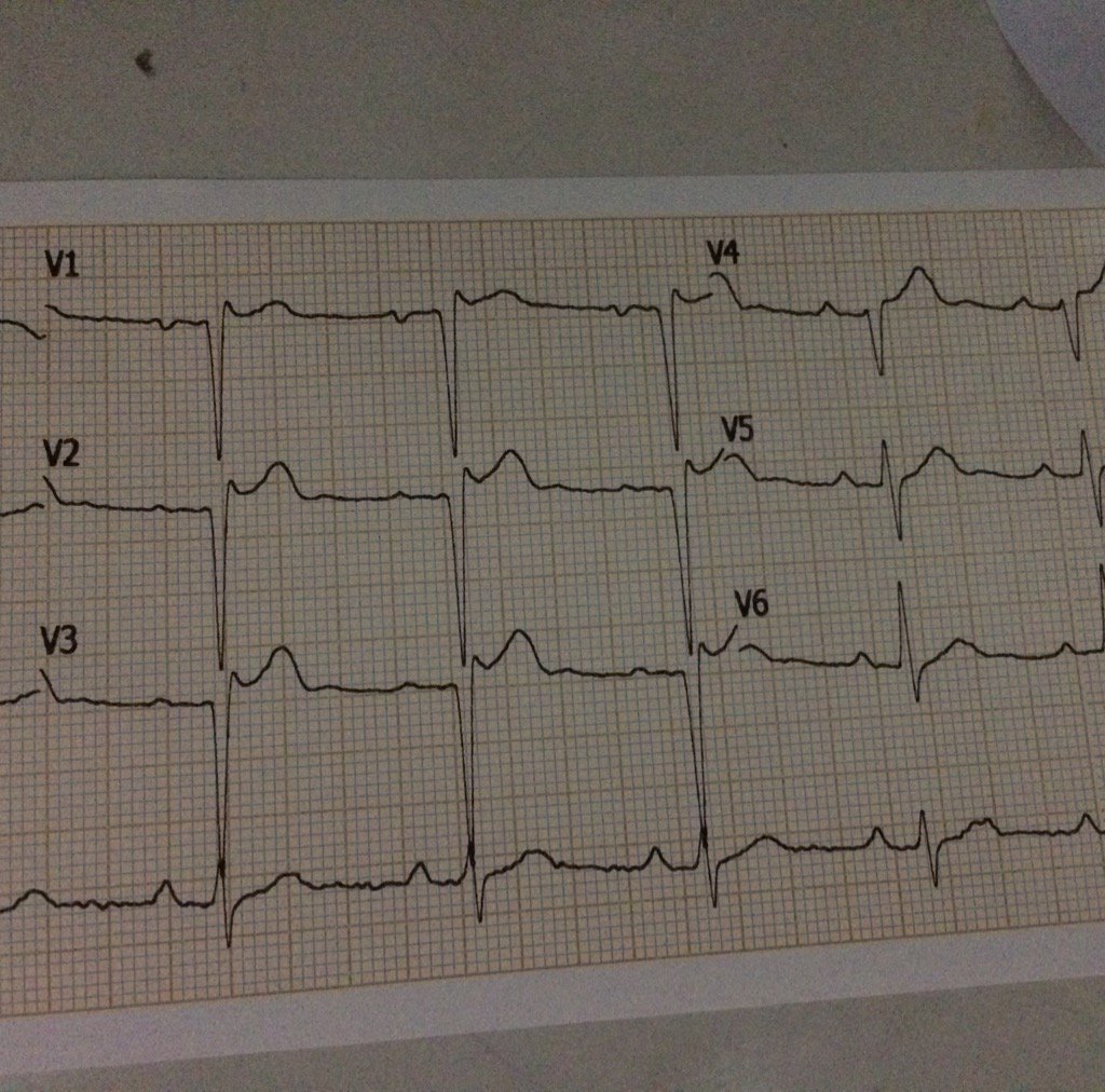 Hasil ekgnya st elevasi v1-v2-v3
