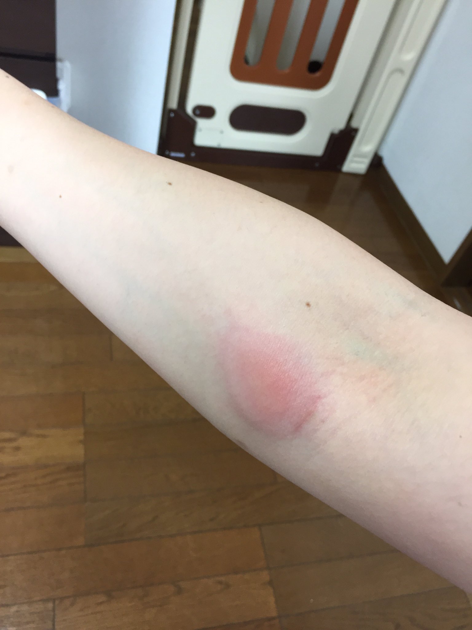 フィナウ律子 虫刺されが巨大化した 痒いというより痛い 蚊じゃなくてブヨ T Co X009dtaujs Twitter